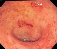 Imagen endoscópica de colon sigmoide afecto de colitis ulcerosa. Tomada de la Wikipedia.
